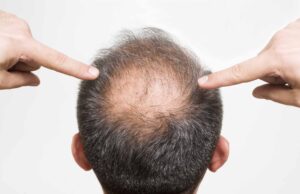 हेयर लॉस के शुरुआती संकेत, समय रहते पहचानें वरना बढ़ सकता है गंजापन