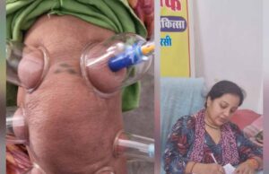 लोहरसी आयुर्वेदिक औषधालय में दर्द प्रबंधन हेतु कपिंग थेरेपी एवं विशेष आयुर्वेदिक उपचार सेवाओं का आरंभ