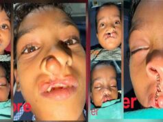 चिरायु योजना से जन्मजात समस्या से मिली राहत, तीन बच्चों के चेहरों पर लौटी मुस्कान